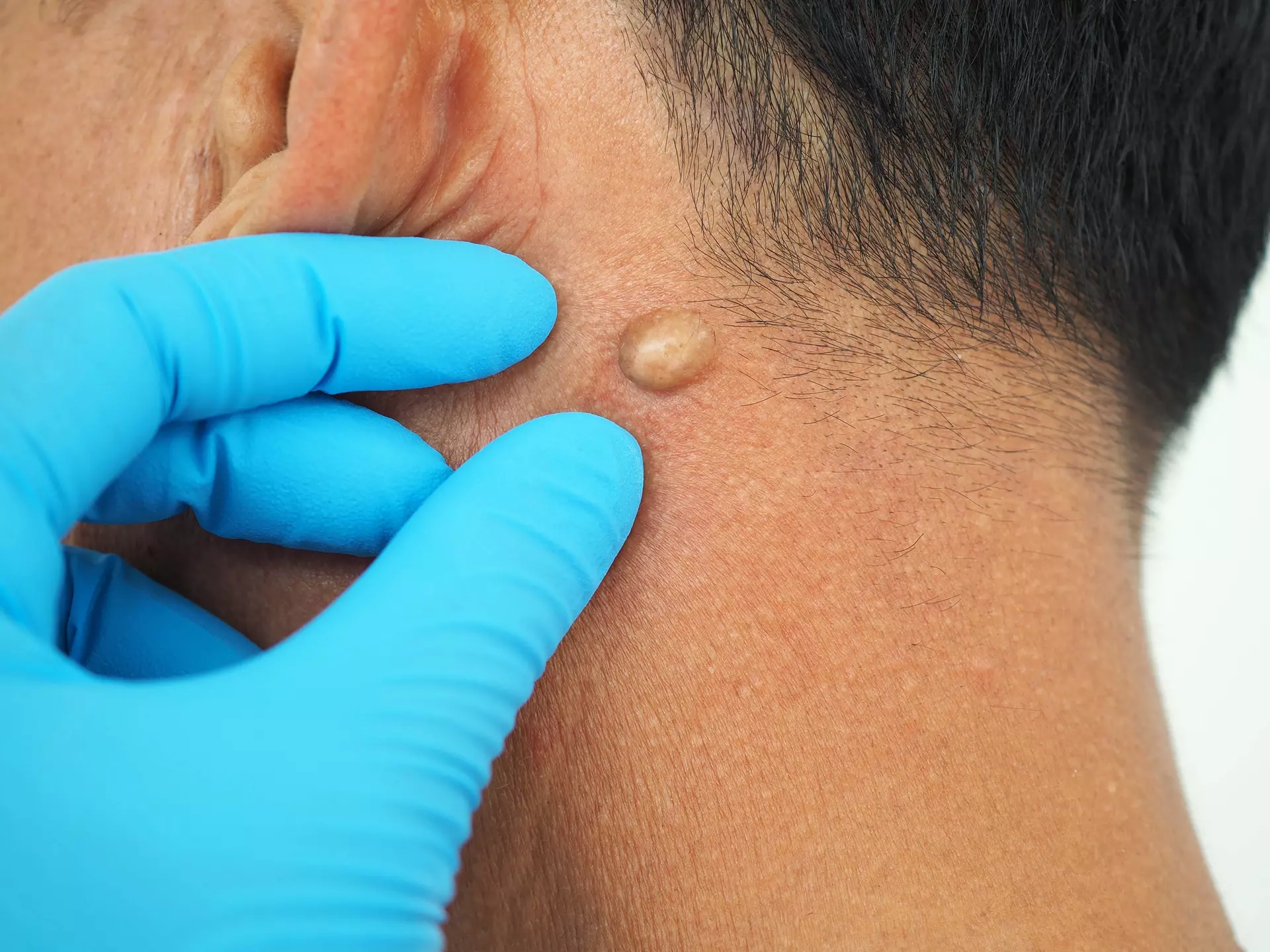 Cyst & Lipoma Removal